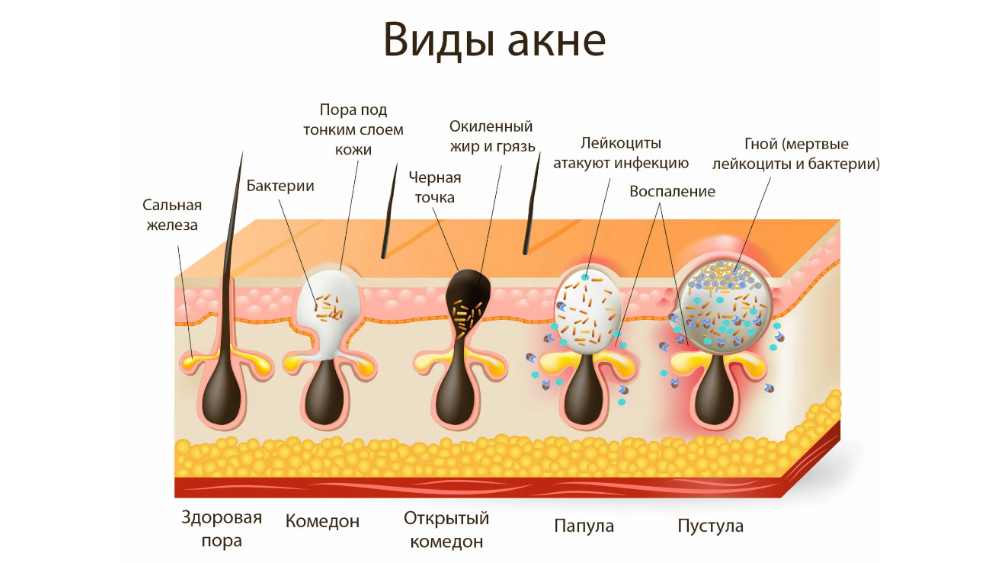Схема строения волосяного фолликула и комедона