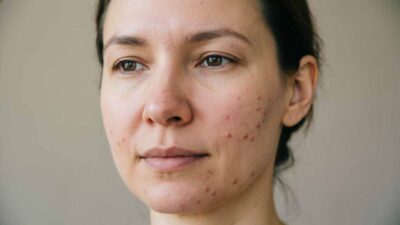 Проблемная кожа: причины, типы, уход и кабинетные решения